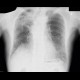 Bullous emphysema, lung tumour: X-ray - Plain radiograph